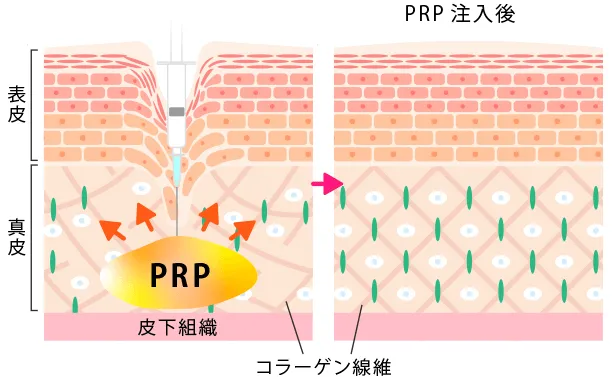 高濃度プレミアムPRP