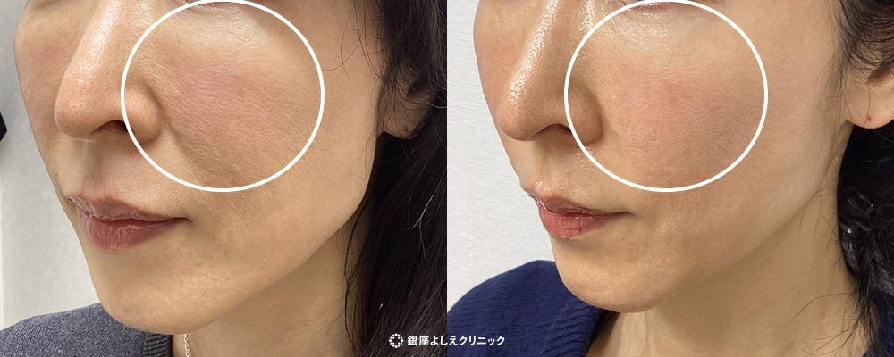 肌の再生医療（線維芽細胞治療）