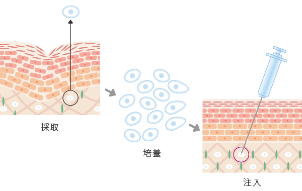 肌の再生医療（線維芽細胞治療）