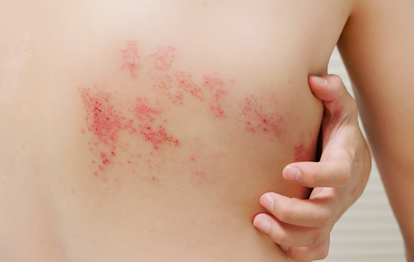 帯状疱疹後神経痛治療（自己脂肪組織由来間葉系幹細胞の静脈点滴）