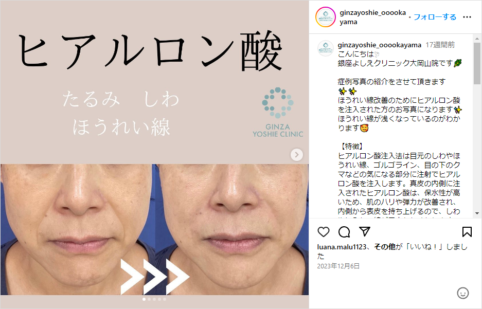 銀座よしえクリニックのInstagram ヒアルロン酸