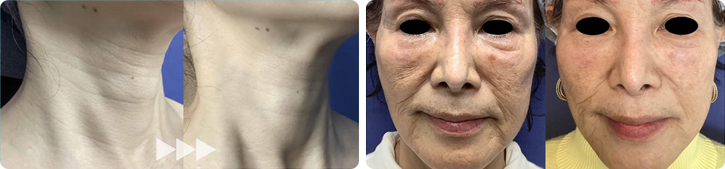 中顔面・下顔面(ちゅうがんめん・かがんめん)の老化集中治療 症例写真