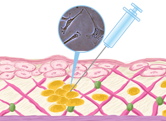 肌の再生医療（線維芽細胞治療）
