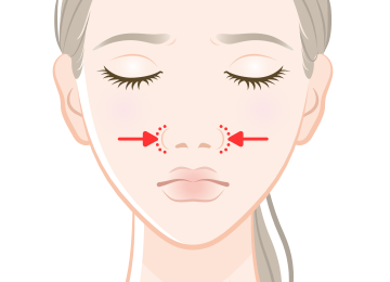 小鼻縮小の場合