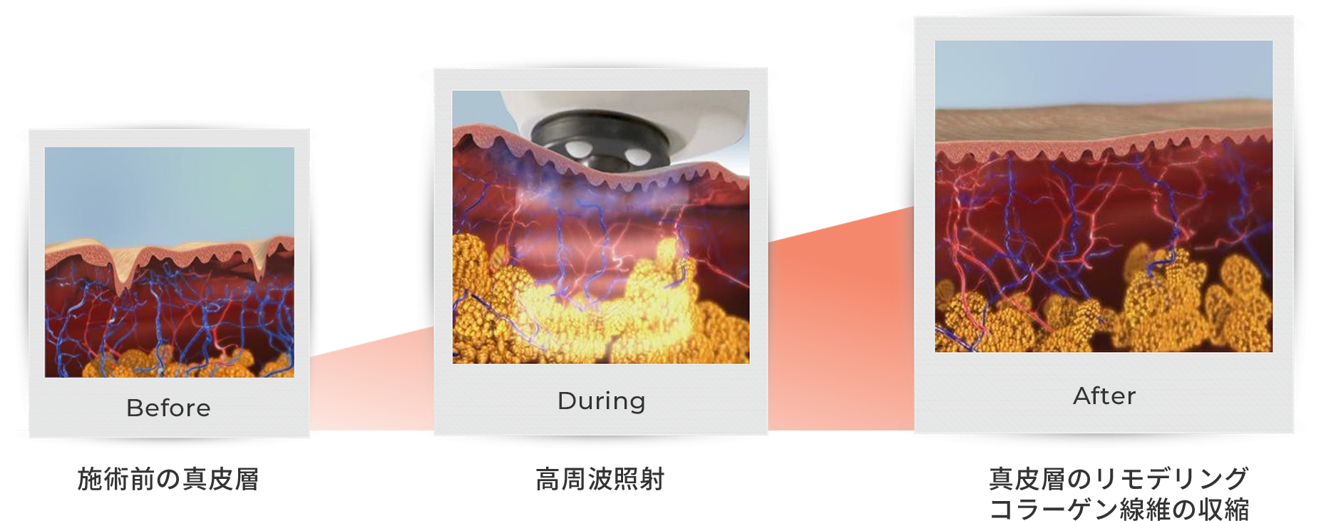 高周波（RF）による皮膚の引き締め