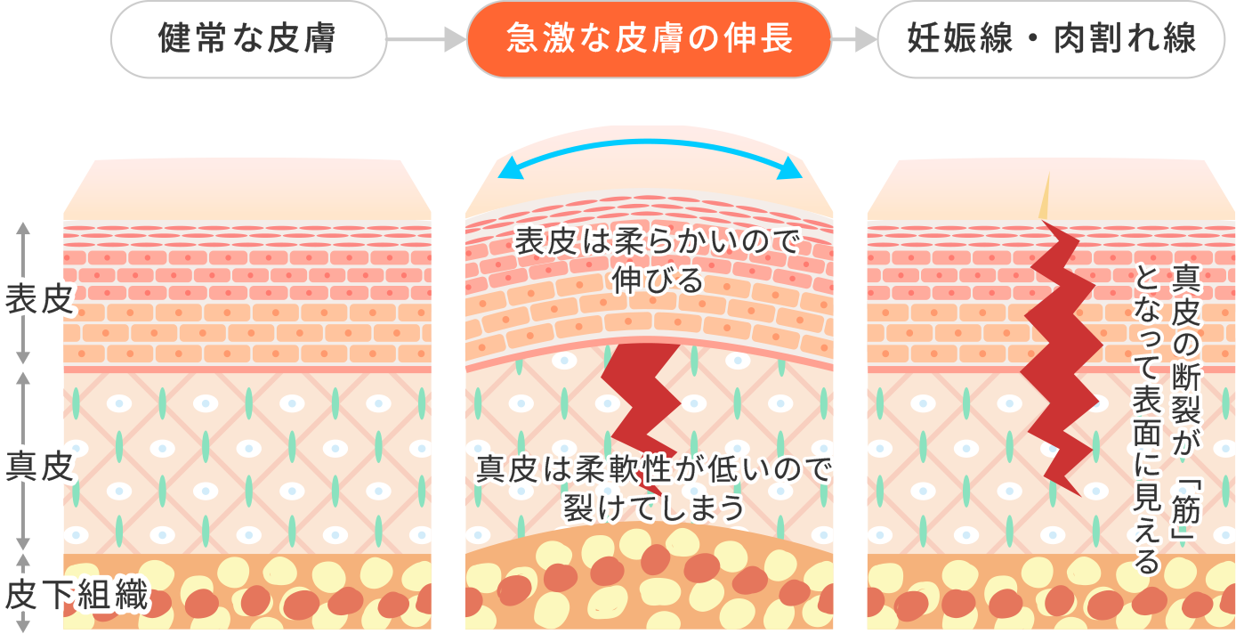 妊娠線（ストレッチマーク）・肉割れの集中ケア