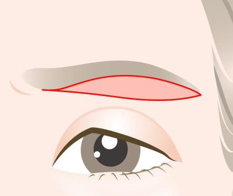 皮膚切開部位に局所麻酔