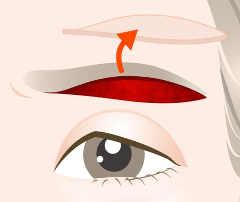 デザインに沿って余った皮膚を切除