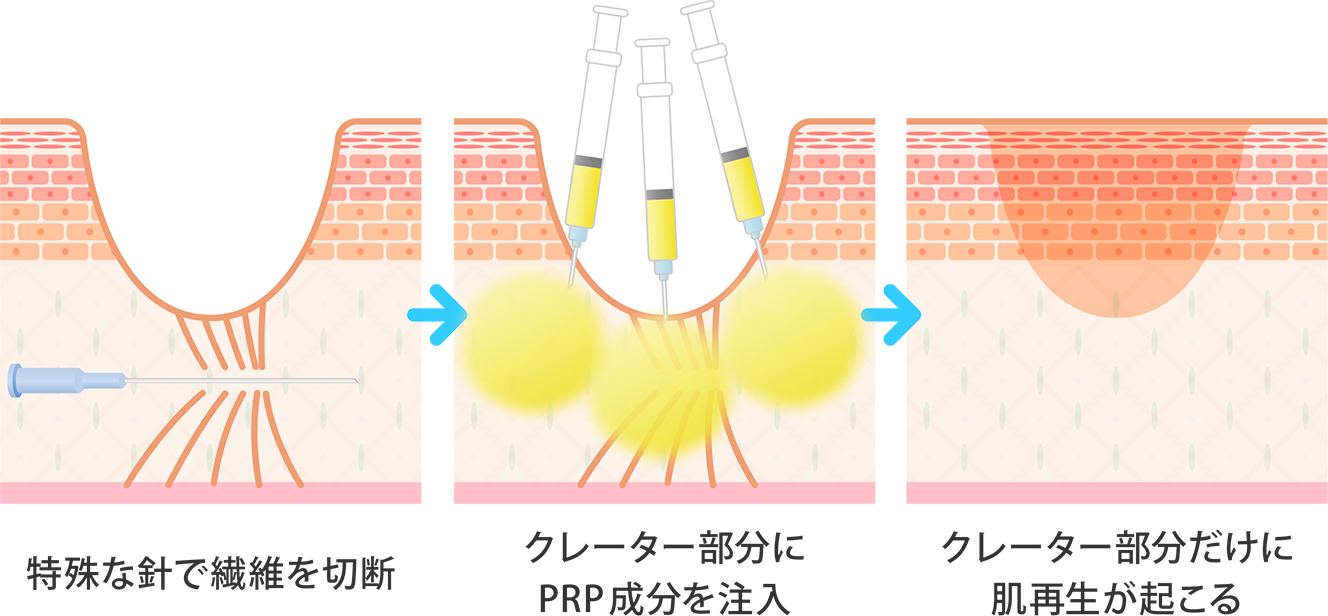 サブシジョンとCPC-PRP®のコンビネーション治療