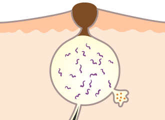 毛穴が詰まる