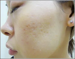 パールフラクショナルレーザー 美容皮膚科 銀座よしえクリニック 公式 東京