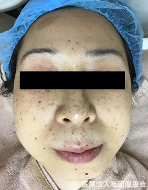 ライムライト Ipl 光治療 美容皮膚科 銀座よしえクリニック