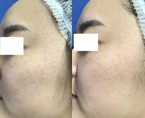 毛穴開き 黒ずみの症例写真 美容皮膚科 銀座よしえクリニック 公式 東京