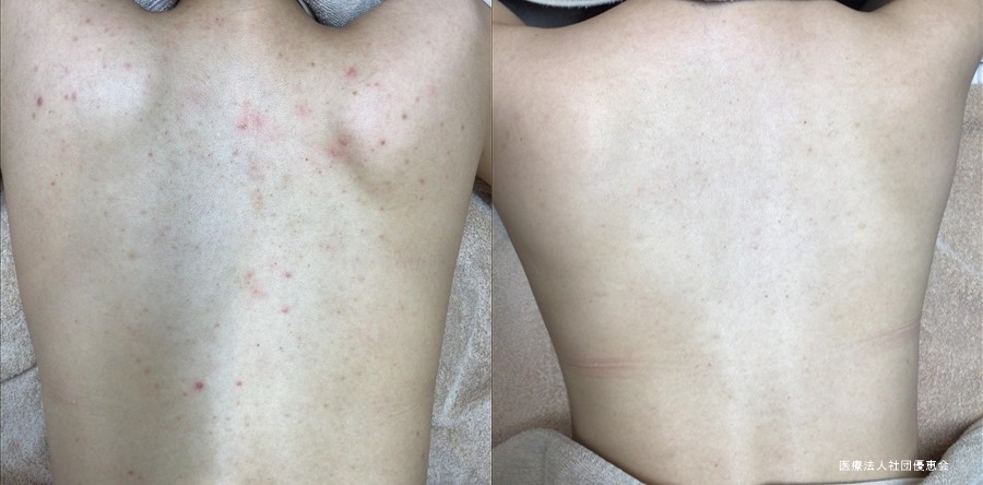 にきび にきび跡の症例写真 美容皮膚科 銀座よしえクリニック 公式 東京