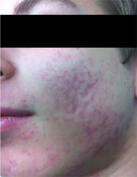 しわ たるみの症例写真 美容皮膚科 銀座よしえクリニック 公式 東京