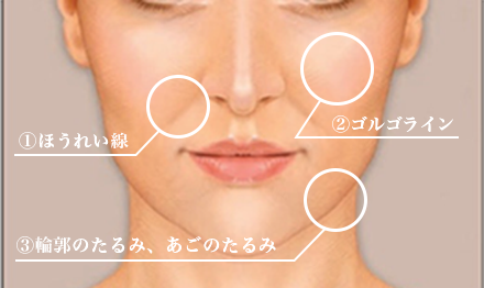 即効型 頬のたるみ ほうれい線 解消治療 美容皮膚科 銀座よしえクリニック 公式 東京