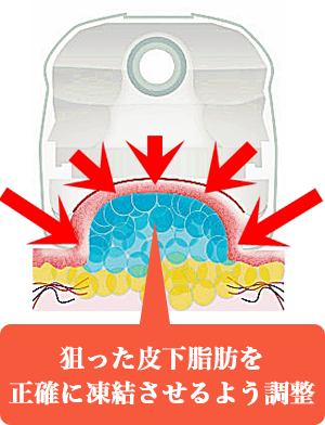 狙った皮下脂肪を正確に凍結させるよう調整