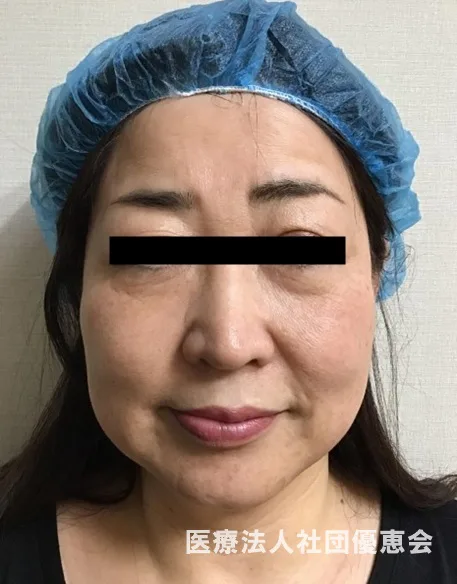 ハイフ Hifu 顔のたるみ 目元のたるみ治療 ウルセラ ウルトラフォーマー3 美容皮膚科 銀座よしえクリニック 公式 東京