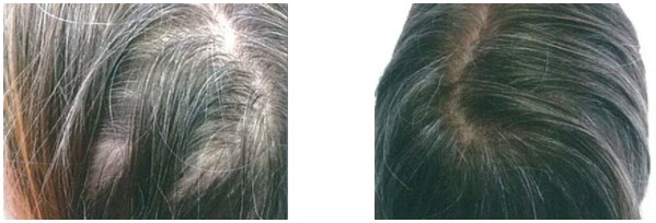 白髪 脱毛症改善治療 白髪注射hairline 美容皮膚科 銀座よしえクリニック 公式 東京