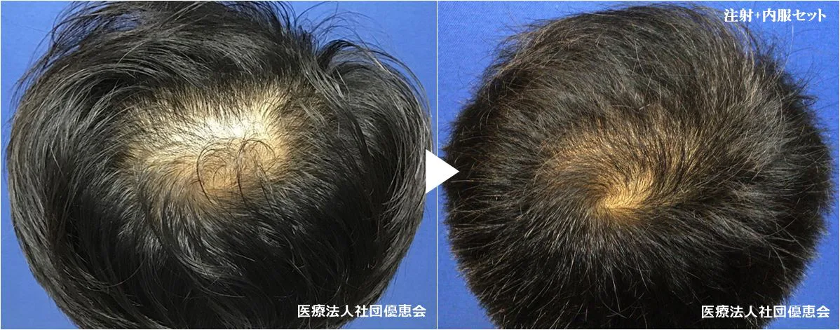 白髪 脱毛症改善治療 白髪注射hairline 美容皮膚科 銀座よしえクリニック 公式 東京