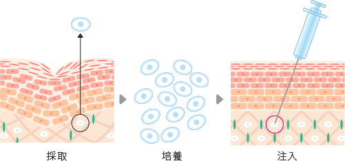 線維芽細胞治療の流れ