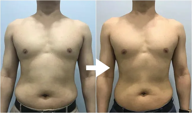ネオベラ Neobella 脂肪溶解注射 美容皮膚科 銀座よしえクリニック 公式 東京 ネオベラ Neobella 脂肪溶解注射 美容皮膚科 銀座よしえクリニック 公式 東京