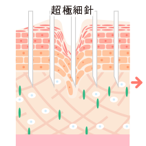 ダーマペンの仕組み1