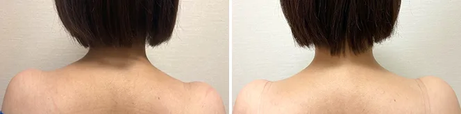 肩ボトックス 首を長くする注射 美容皮膚科 銀座よしえクリニック 公式 東京 肩ボトックス 首を長くする注射 美容皮膚科 銀座よしえクリニック 公式 東京