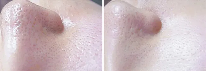 毛穴開き 黒ずみの症例写真 美容皮膚科 銀座よしえクリニック 公式 東京