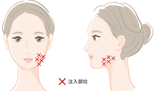 エラボトックス注射 美容皮膚科 銀座よしえクリニック 公式 東京 エラボトックス注射 美容皮膚科 銀座よしえクリニック 公式 東京