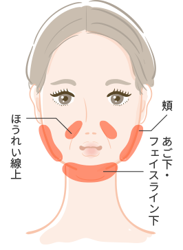 Bnls注射 美容皮膚科 銀座よしえクリニック 公式 東京 Bnls注射 美容皮膚科 銀座よしえクリニック 公式 東京