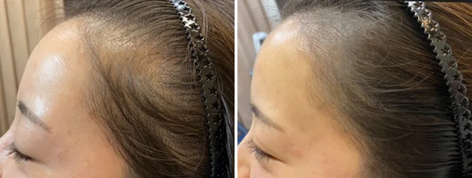 アートメイク ヘアライン 生え際 美容皮膚科 銀座よしえクリニック 公式 東京