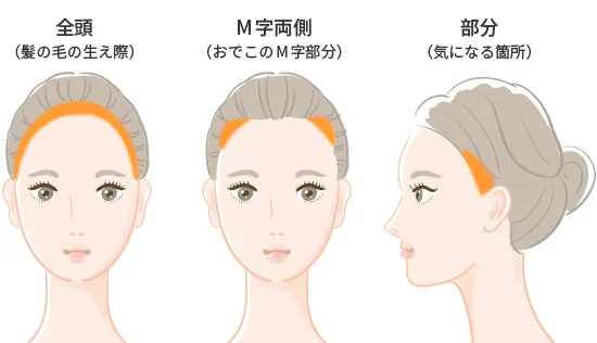アートメイク ヘアライン 生え際 美容皮膚科 銀座よしえクリニック 公式 東京 アートメイク ヘアライン 生え際 美容皮膚科 銀座よしえクリニック 公式 東京