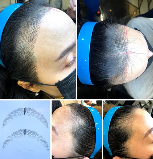 アートメイク ヘアライン 生え際 美容皮膚科 銀座よしえクリニック 公式 東京 アートメイク ヘアライン 生え際 美容皮膚科 銀座よしえクリニック 公式 東京