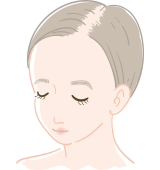 びまん性脱毛症