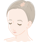 粃糠性(ひこうせい)脱毛症・脂漏性(しろうせい)脱毛症