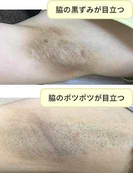 脇の黒ずみ除去 治療 美容皮膚科 銀座よしえクリニック 公式 東京