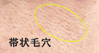 たるみ毛穴 帯状毛穴 治療 美容皮膚科 銀座よしえクリニック 公式 東京