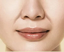 即効型 頬のたるみ ほうれい線 解消治療 美容皮膚科 銀座よしえクリニック 公式 東京