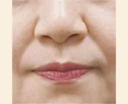 即効型 頬のたるみ ほうれい線 解消治療 美容皮膚科 銀座よしえクリニック 公式 東京 即効型 頬のたるみ ほうれい線 解消治療 美容皮膚科 銀座よしえクリニック 公式 東京