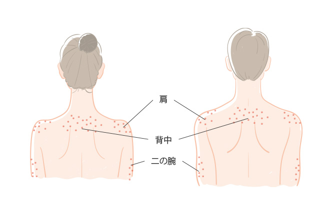 ひどい背中ニキビの原因と治し方。有効な6つの治療方法をご紹介