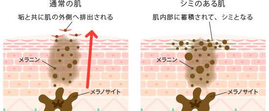 シミ断面図