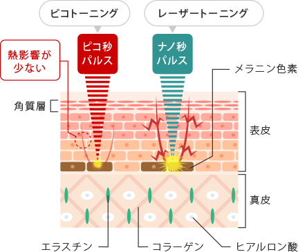 レーザートーニングとピコトーニングの違い