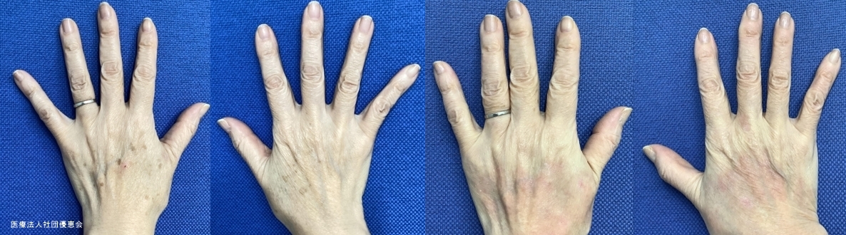 手の甲　シミ取りレーザー 施術前 / トレチノイン療法2ヶ月後