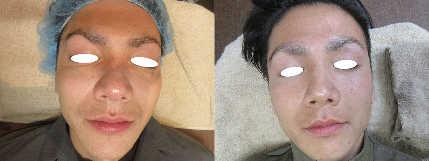 PRP注射（多血小板血漿を用いた皮膚再生治療）全顔1回 施術前／施術後