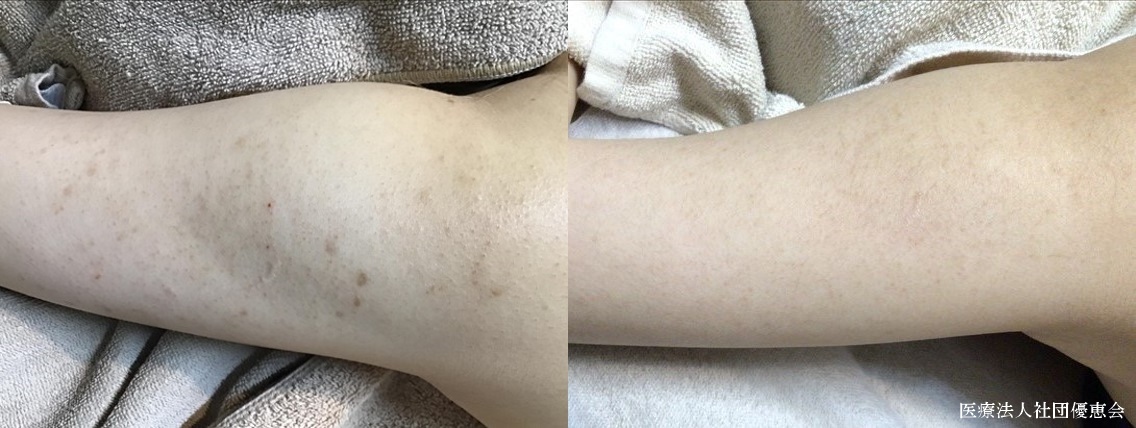 ダーマペン+ウーバーピール　二の腕の毛孔性苔癬 施術前/施術後