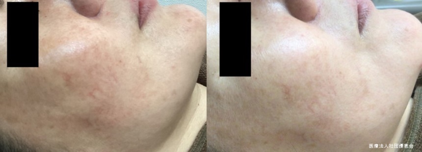 赤いしみ、赤ら顔、鼻の血管治療：エクセルホワイト+TA導入　1回 施術前/施術3週間後