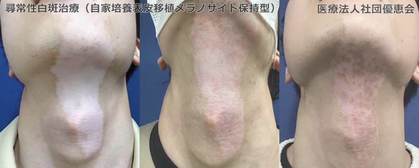 培養表皮移植による白斑治療＋エキシマライト 左：移植前 / 中央：移植後1か月(治療中) / 右：移植+エキシマ(治療中)