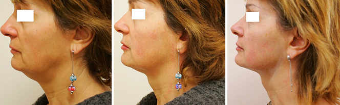 首のシワ治療：ウルトラフォーマー3 フルフェイスパーフェクト+首 2回 治療前／直後／6ヶ月後