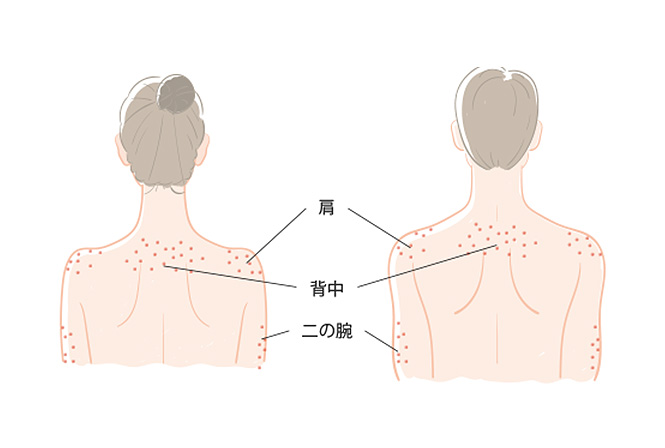 ひどい背中ニキビの原因と治し方。有効な6つの治療方法をご紹介